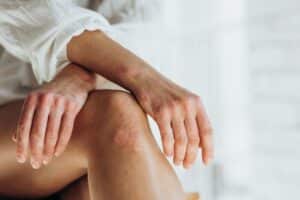 Woman experiencing pain relief after bursitis treatment in Ogden, UT
